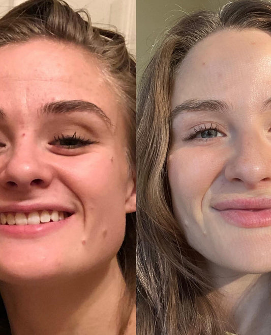 Acne Awareness Month!